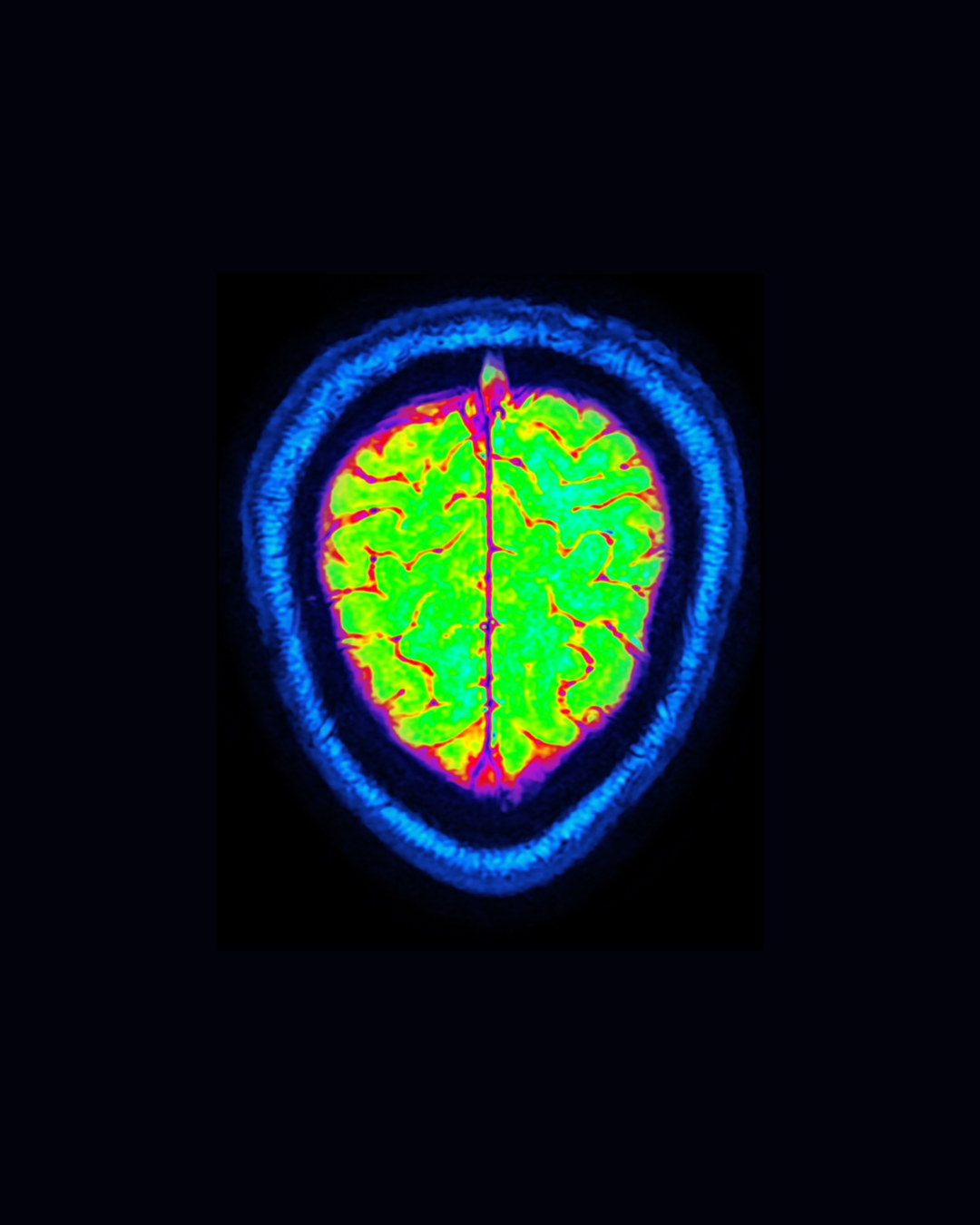 PMDD is Visible on Brain Scans